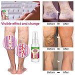 Load image into Gallery viewer, Healing Varicose Veins Treatment Spray 50 ml